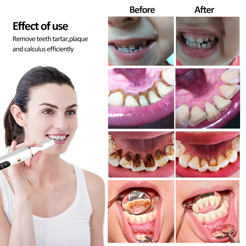 Other Oral Hygiene G6 Ultrasonic Dental Calculus Remover Teeth Plaque Tartar Eliminator Stains Cleaner Electric Dental Tooth Stone Remover 230815
