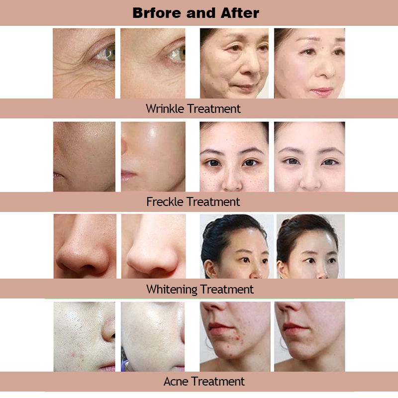 2023 14 In 1 Rejuvenation Beauty Machine Jet Peel Machine Price for Skin Tightening