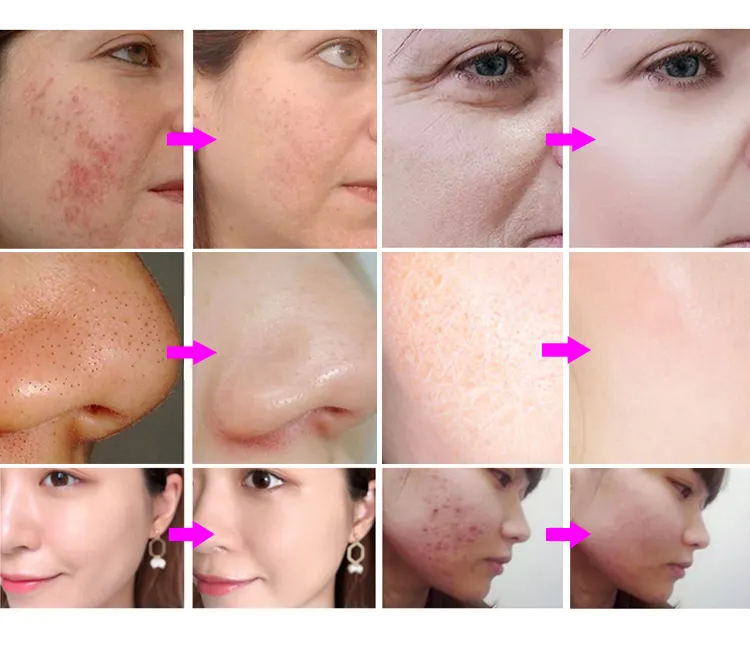 Multifunctional oxygen spray dermabrasion deep cleaning skin tightening face care device