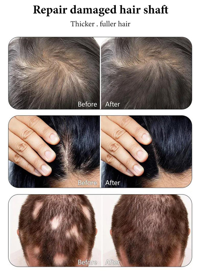 2023 5IN1 Hair Growth 650nm Diode Laser Machine Scalp Detection Painless Anti-hair Loss Treatment High Frequence Hair Regrowth Device