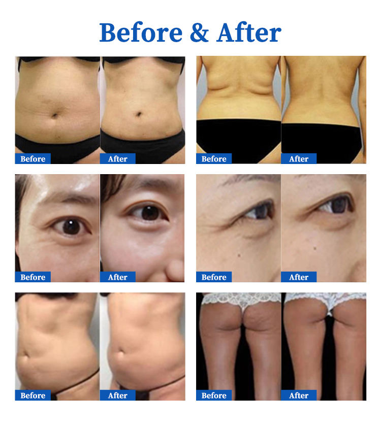 Portable Body Slimming Machine Face Lift Fat Burning Cellulite Reduction RF Machine With 2 Handles