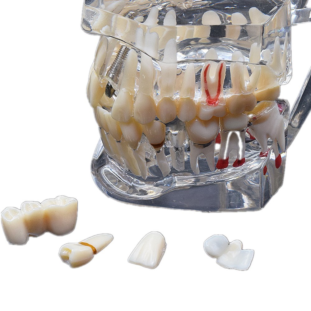 Other Oral Hygiene Dental Consumable Teeth Model Studying Implant Disease With Restoration Bridge Tooth Teaching 230831