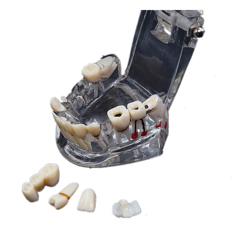 Other Oral Hygiene Dental Consumable Teeth Model Studying Implant Disease With Restoration Bridge Tooth Teaching 230831