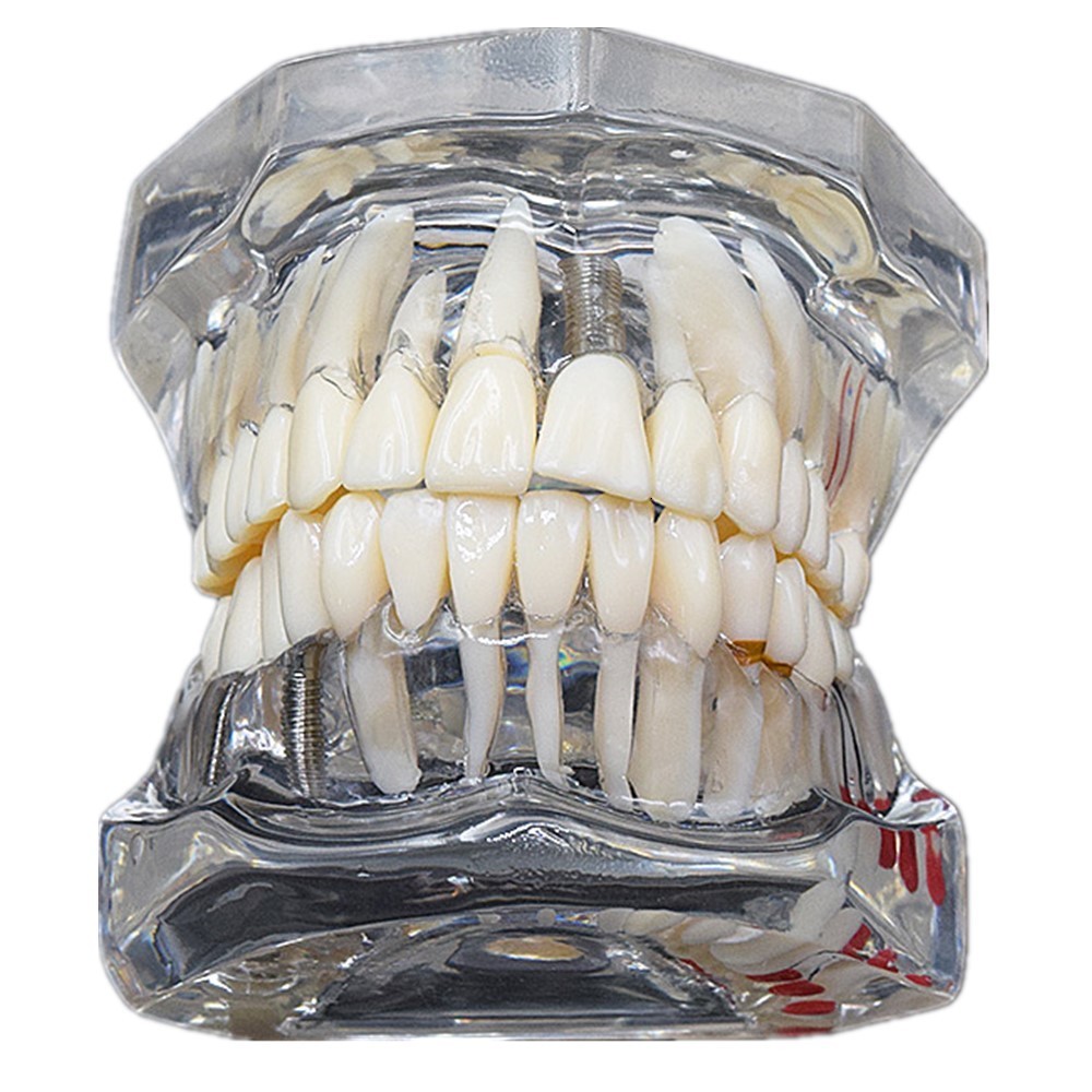 Other Oral Hygiene Dental Consumable Teeth Model Studying Implant Disease With Restoration Bridge Tooth Teaching 230831