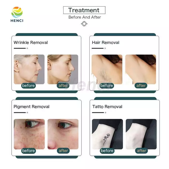 Multifunctional machine e light ipl rf beauty equipment elight skin care acne treatment use manual approved