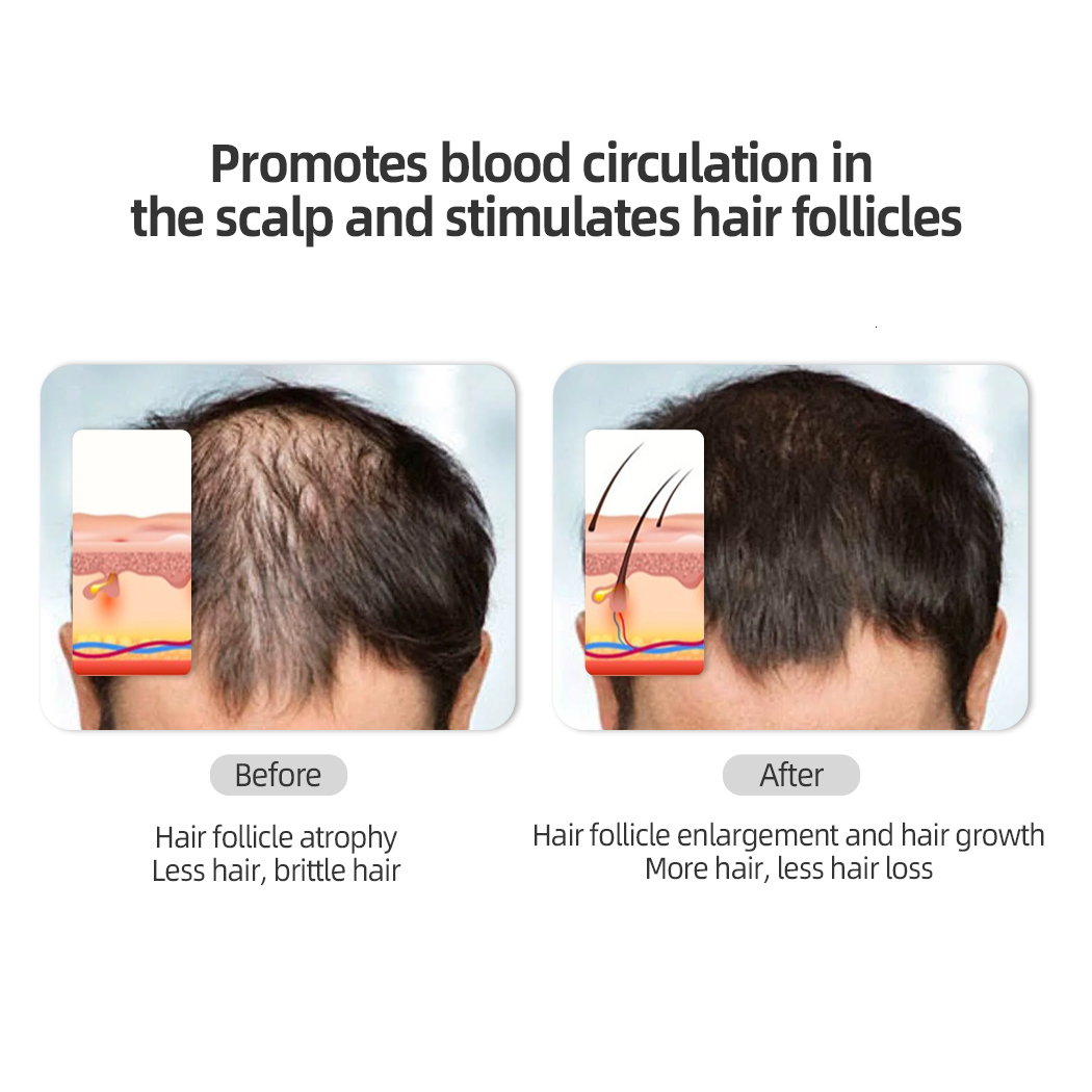 Hair Brushes CkeyiN Electric Massage Comb Blue Red Light Therapy Vibration Scalp Brush Negative Ion Spray Growth r 230317