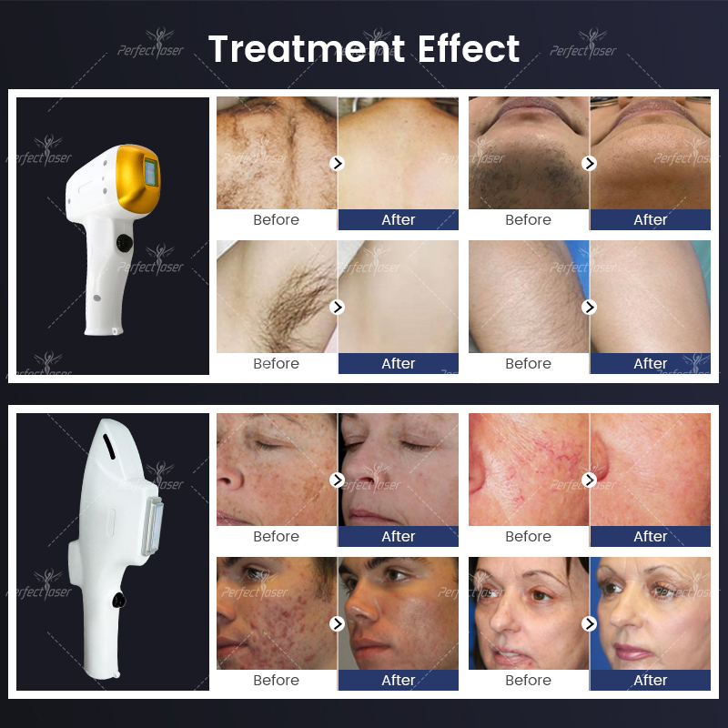 Multifunction Diode Laser Beauty Equipment Permanent Hair Removal Machine IPL Elight skin rejuvenation treatment