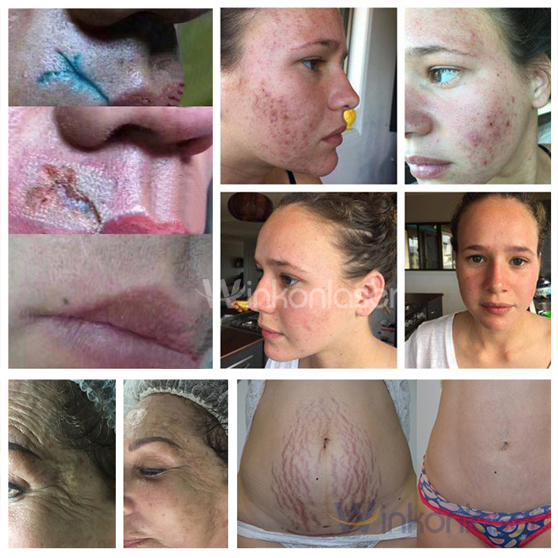 2023 Latest Co2 Fractional Laser Machine For Wrinkles Pore Scar Acne Removal Skin Rejuvenation Vaginal Tightening Beauty Face