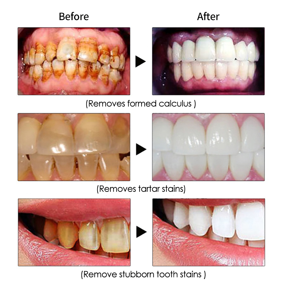 Other Oral Hygiene Ultrasonic Dental Electric Teeth Cleaner Calculus Tartar Remover High Frequency Sonic Vibration Tooth Cleaning Whitening 230503