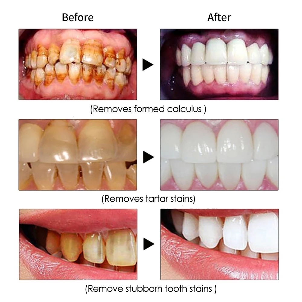 Other Oral Hygiene Ultrasonic Dental For Teeth Tartar Stain Tooth Calculus Remover Electric Sonic Teeth Plaque Cleaner Dental Stone Removal 230503