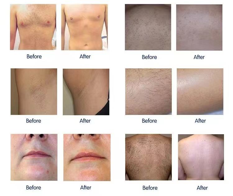 2023 Diode Laser Hair Removal Machine Skin Rejuvenation 755nm 808nm 1064nm Triple Wavelength Fast Permanent Hair Remover 50 Million Shots