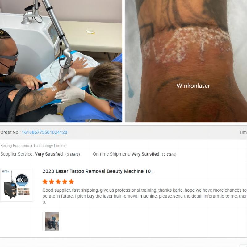 450PS Picosecond Pico laser tattoo Removal Machine