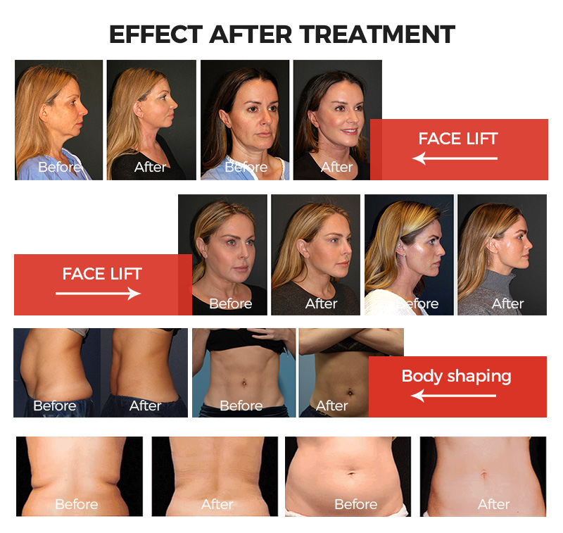 anti aging hifu rf with cooling machine ice hifu cool hifu portable machine korea skin tighten device vaginal rejuvenation