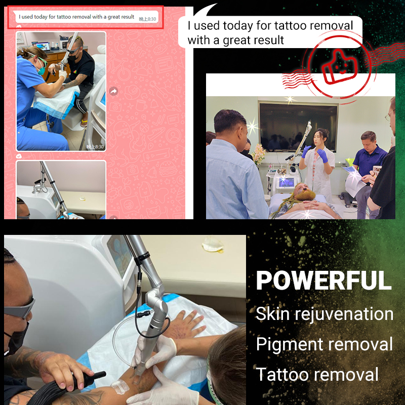 450PS Picosecond Pico laser tattoo Removal Machine