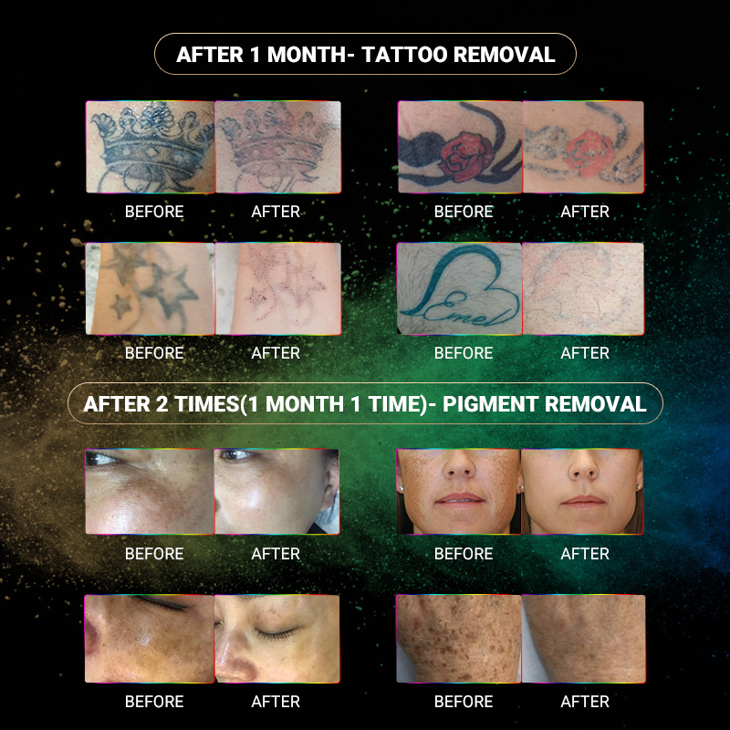 450PS Picosecond Pico laser tattoo Removal Machine