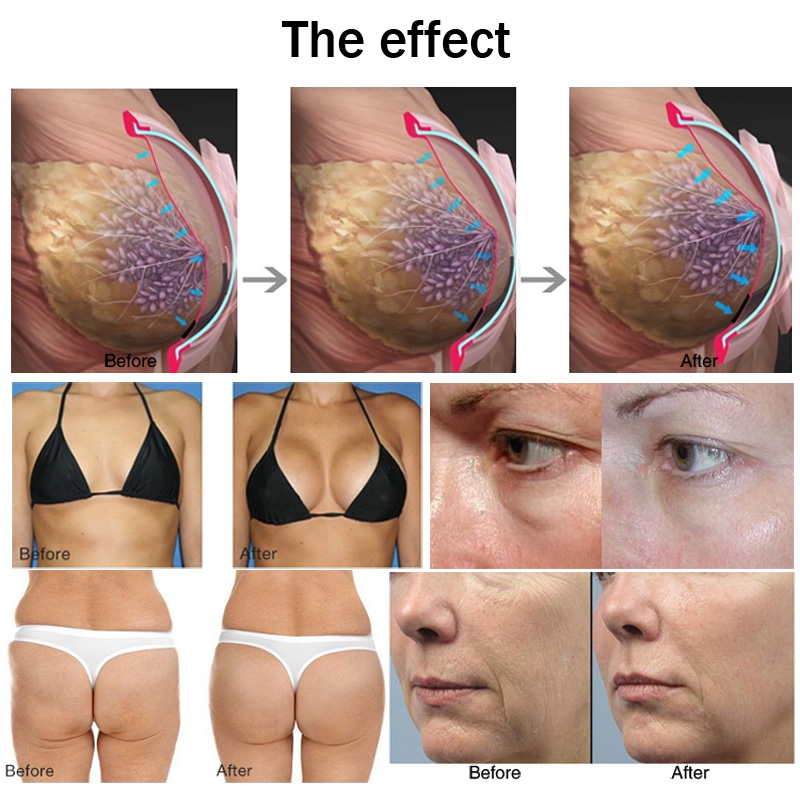 Focused RF radio frequency body slimming vacuum therapy buttock lifting face lift breast enlargement spa salon beauty machine
