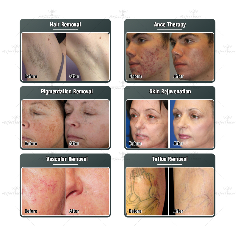 CE Approved IPL OPT permanently laser hair removal nd yag lazer tattoo remove multifunction machine rf face lift elight