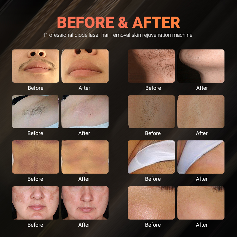 best lezar professional laser diode 755 808 1064 hair removal machine 2 handles long life use