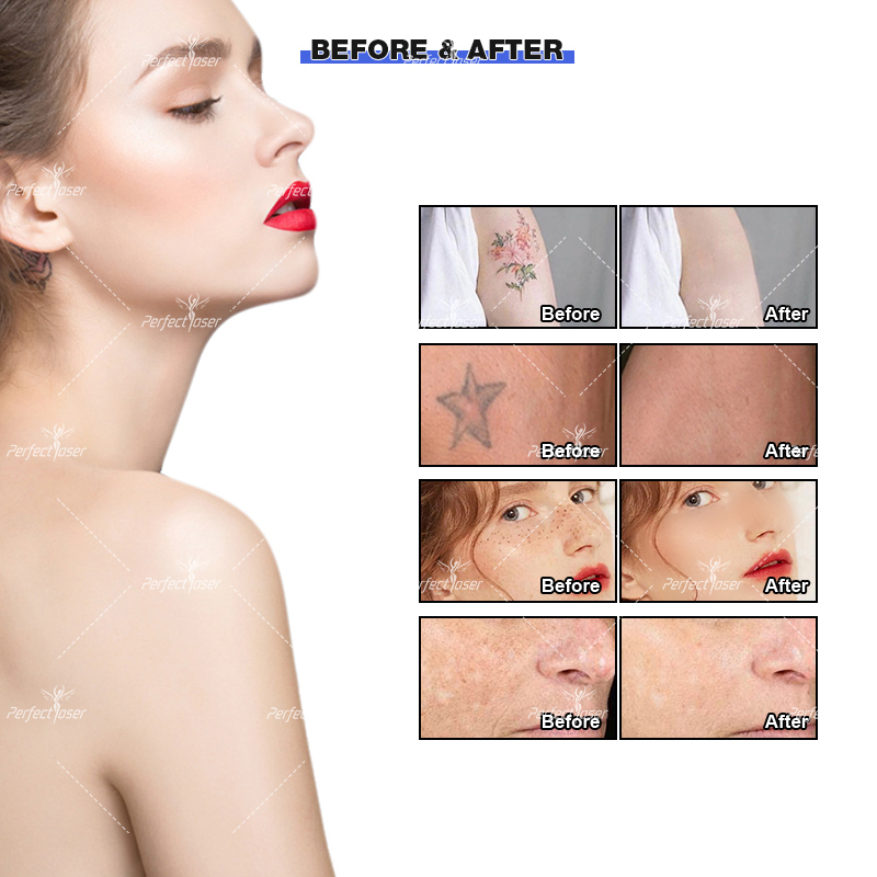 Pico Laser Picosecond Beauty Equipment Picosecond Laser Hyperpigmentation Removal Face Acne Treatment Machine 2 Years Warranty Tattoo Removal Laser Ma