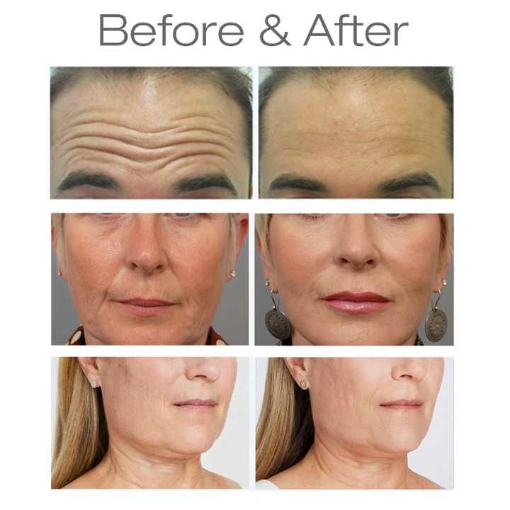 PEface Wrinkle Removal PE rf face Lifting sculpting Ems facial skin tightening machine