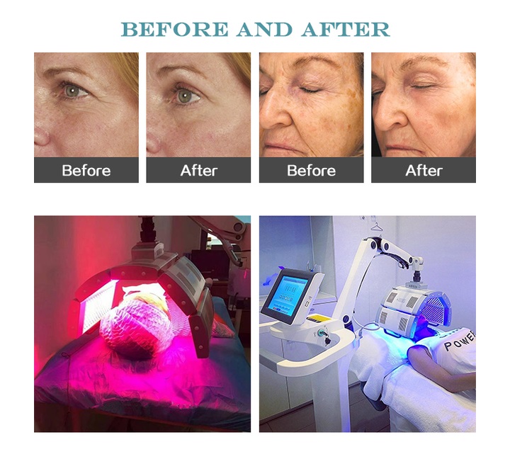 High Quality Pdt Led Bio-light Therapy Facial Light Phototherapy Skin Care machine