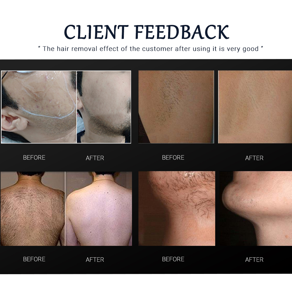 Aressmart 808Nm 755 940 1604 Laser Hair Removal Machine