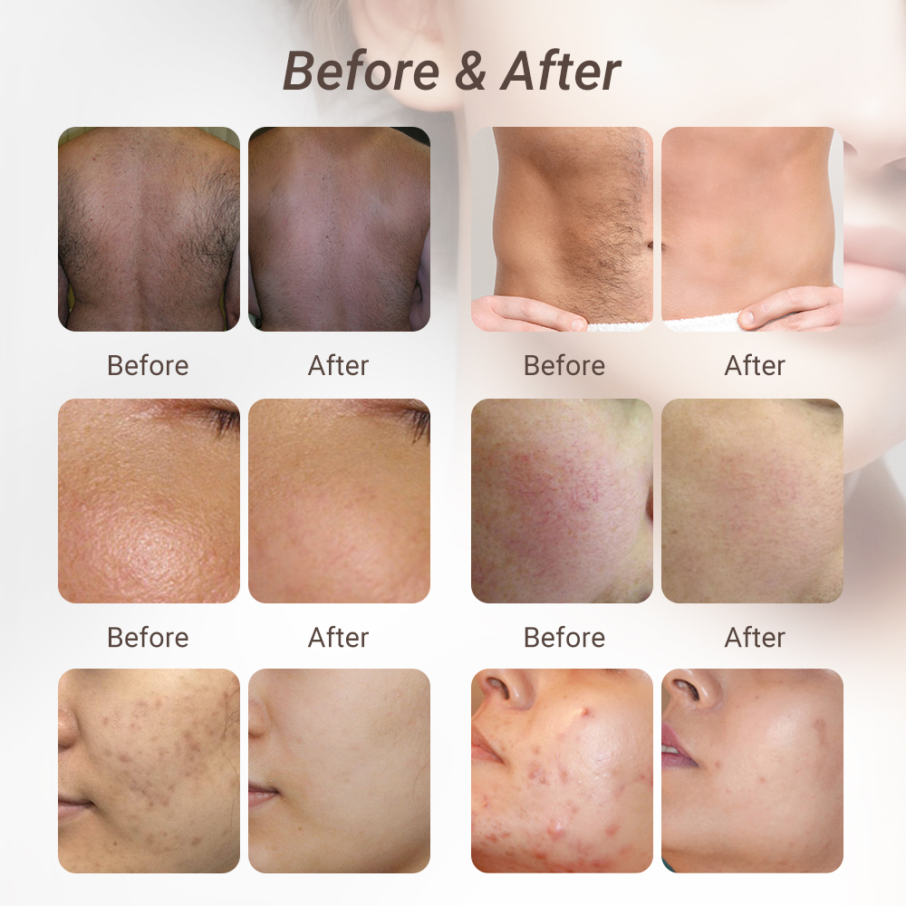 Hot Sale DPL NIR Photorejuvenation Device Beauty Technology For Salon/ Home