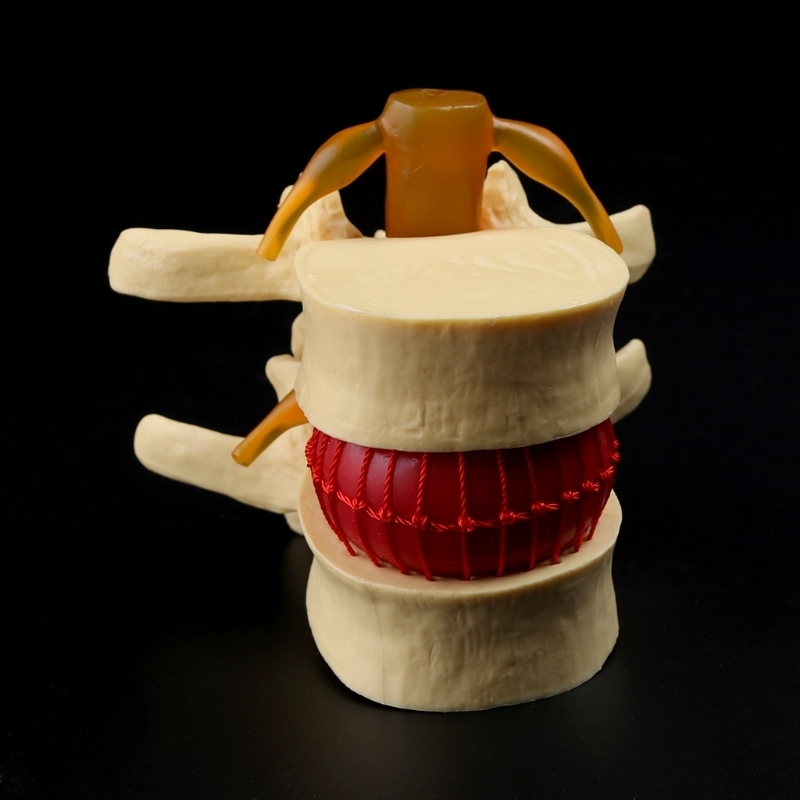 Other Office School Supplies props model Free postage Anatomical Spine Lumbar Disc Herniation Anatomy Teaching Tool 230703