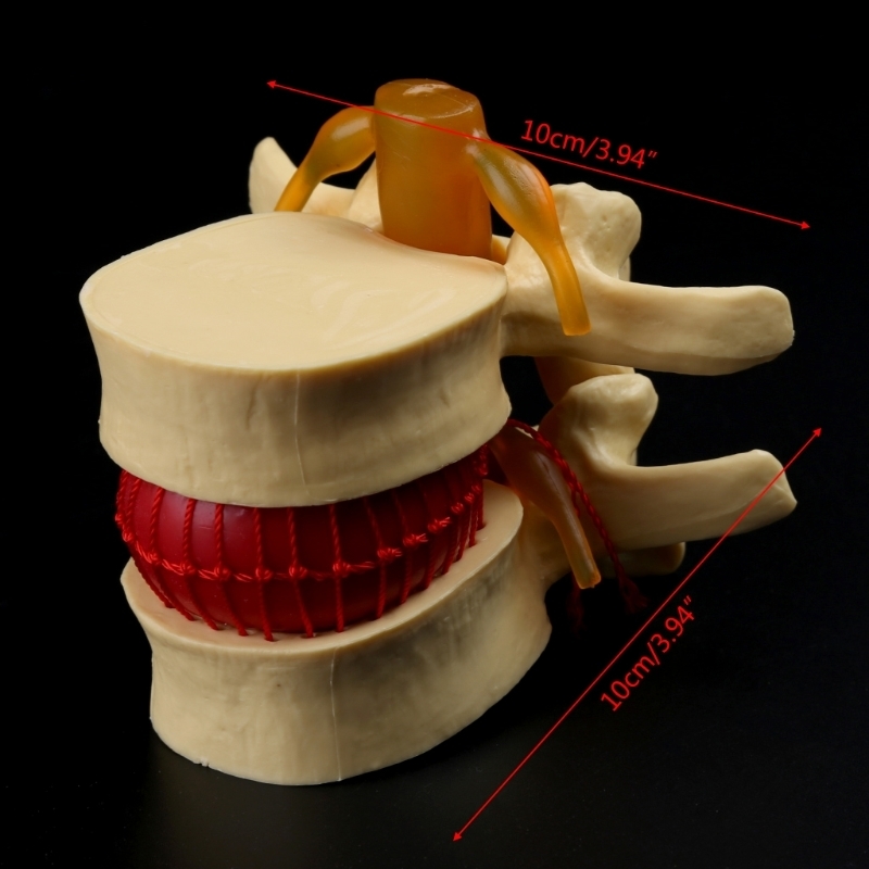 Other Office School Supplies props model Free postage Anatomical Spine Lumbar Disc Herniation Anatomy Teaching Tool 230703