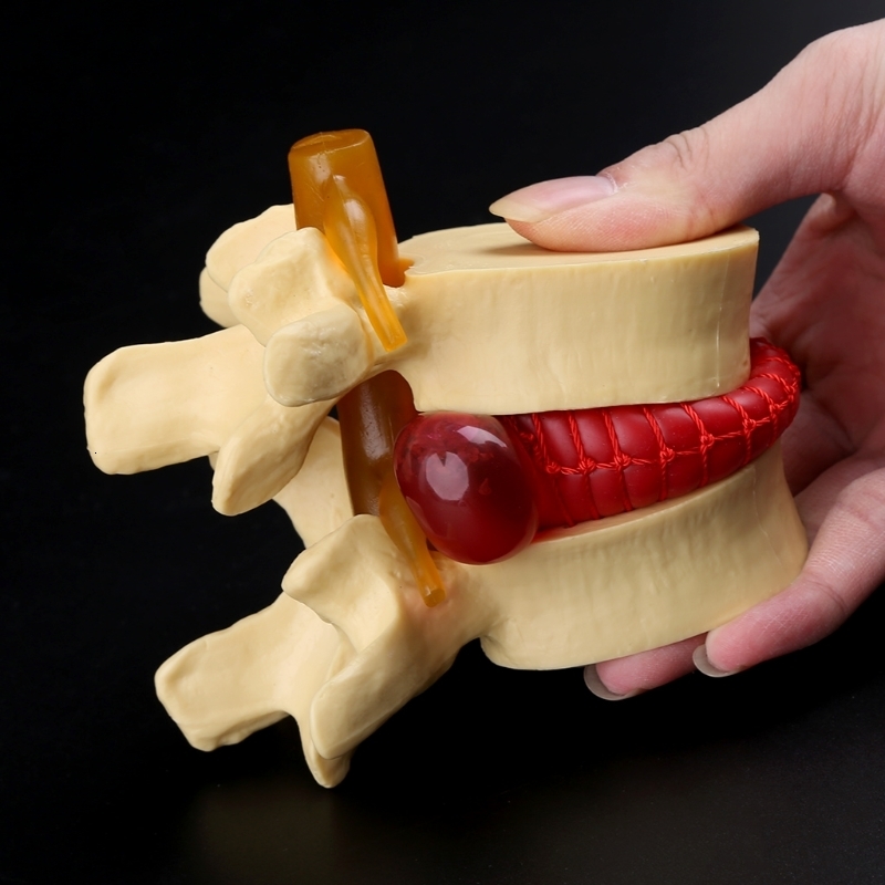 Other Office School Supplies props model Free postage Anatomical Spine Lumbar Disc Herniation Anatomy Teaching Tool 230703