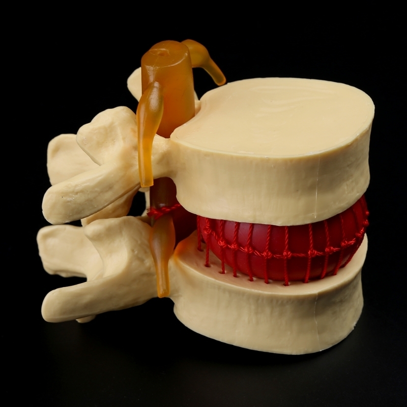 Other Office School Supplies props model Free postage Anatomical Spine Lumbar Disc Herniation Anatomy Teaching Tool 230703