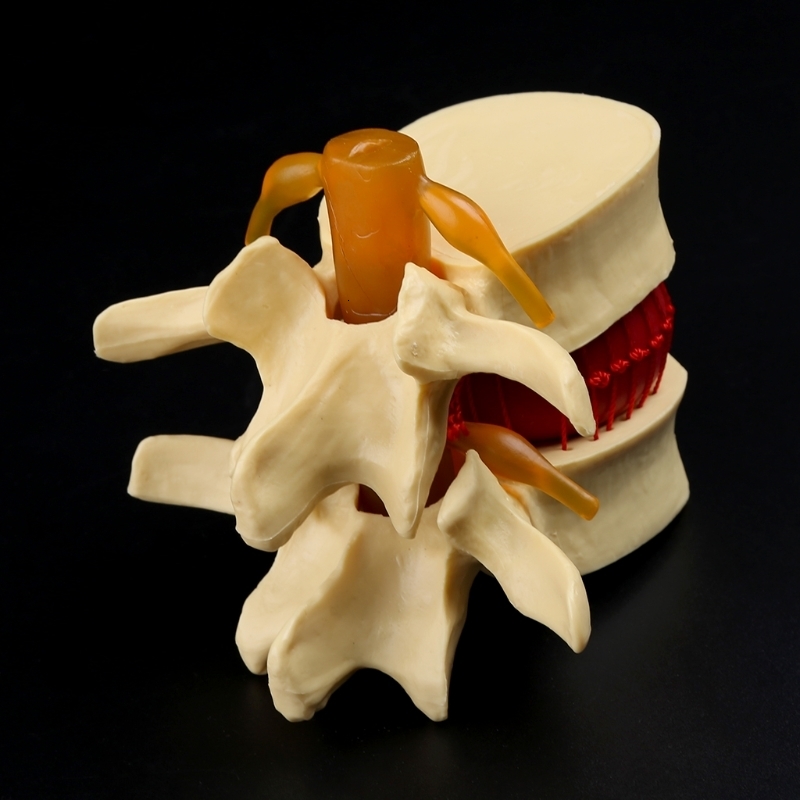 Other Office School Supplies props model Free postage Anatomical Spine Lumbar Disc Herniation Anatomy Teaching Tool 230703