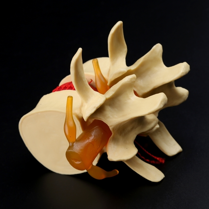 Other Office School Supplies props model Free postage Anatomical Spine Lumbar Disc Herniation Anatomy Teaching Tool 230703