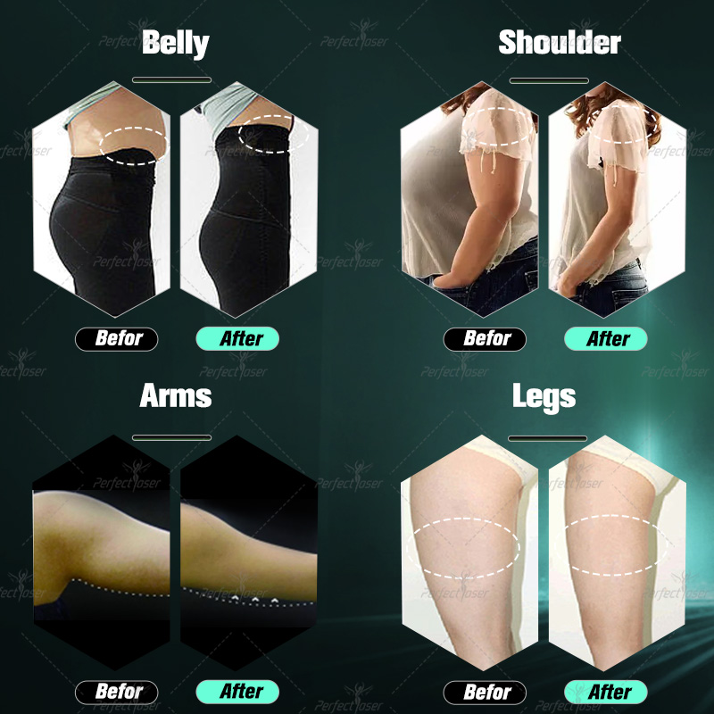 Professional 532nm Emerald Laser Weight Loss Products Fat Removal Cellulite Reduction Fat Burning Slimming Machine Skin Tightening Machine