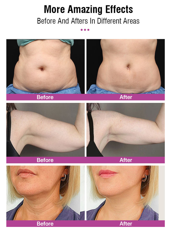 Fat Dissolver Hot Sculpting Cellulite Reduction RF Face Lifting Skin Tightening Weight Loss Body Slimming Machine