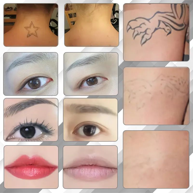 Desktop Q-Switch ND YAG Picosecond Laser Tattoo Removal Pigmentation Removal Carbon Peeling Machine