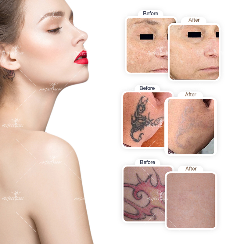 2025 professional Picolaser Tattoo Removal Machine beauty spot laser pigment remove 3 probes equipment ce