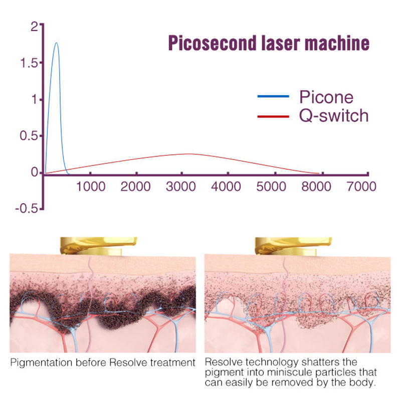 Picosecond 1064 nm 755nm 532nm Pico Q Switched Nd Yag Laser Pico Laser Tattoo Removal Machine