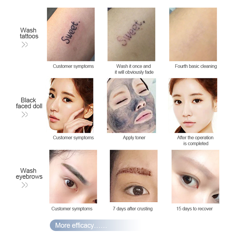 Non-invasive Q Switched Nd Yag Laser Tattoo Removal Beauty Machine/laser Carbon Peeling Tattoo Removal Eyebrow Pigment Therapy Beauty