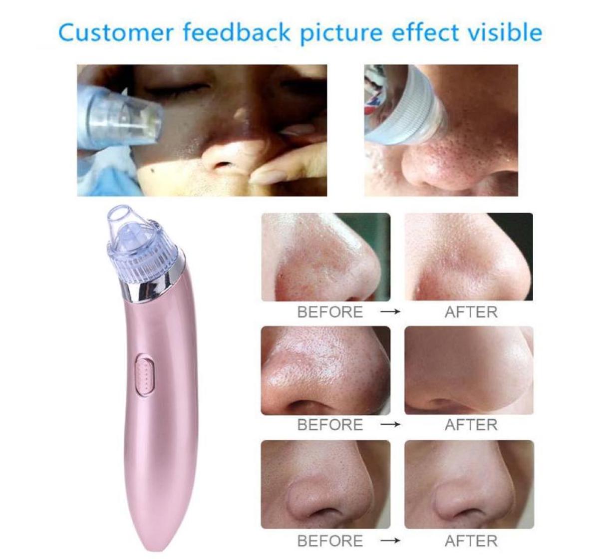 Face Pore Cleaner Blackhead Remover Black Spots Dots Pore Vacuum Comedo Suction Facial Cleaning Pimple Remover Tool