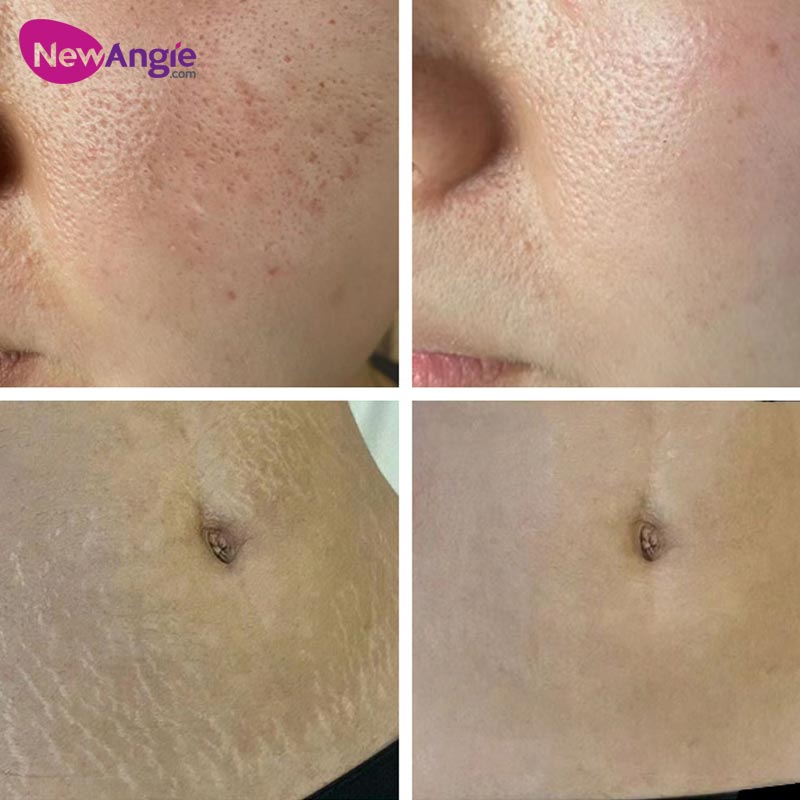 2024 Microneedling RF fractional machine Treatment Scar Removal Stretch Marks Treatment Microneedle Radio Frequency 1 years warranty logo customizatio