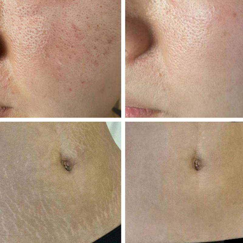 2 years warranty fractional rf microneedle machine Acne Scar Removal Anti-aging face lifting device