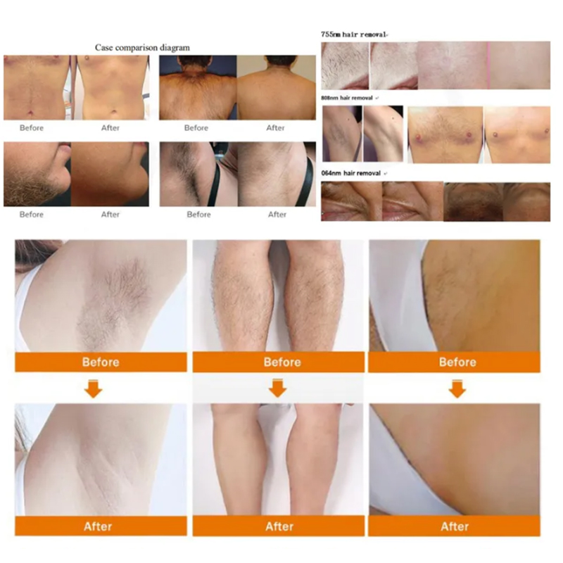 2025 Newest 808Nm Diode Hair Removal Machine 808 755 1064 Permanent Hair Remover Equipment Painless Body Epilator Devic