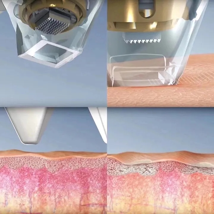 rf microneedling pixel tixel oder not laser 8 fractional beauty skin machine recover treatment acne scars fine line removal reddit resurfacing with on