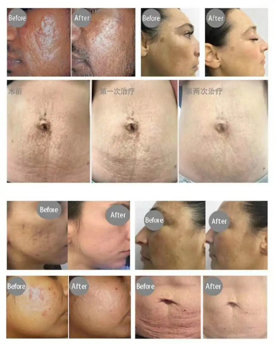 rf microneedling pixel tixel oder not laser 8 fractional beauty skin machine recover treatment acne scars fine line removal reddit resurfacing with on