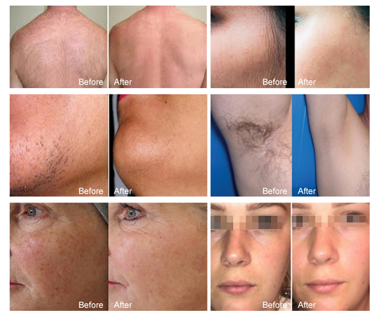 2024 Diode laser hair removal machine 3 wavelength 808nm 755nm 1064nm with 3500 watts skin rejuvenation 3 times remove hair forever