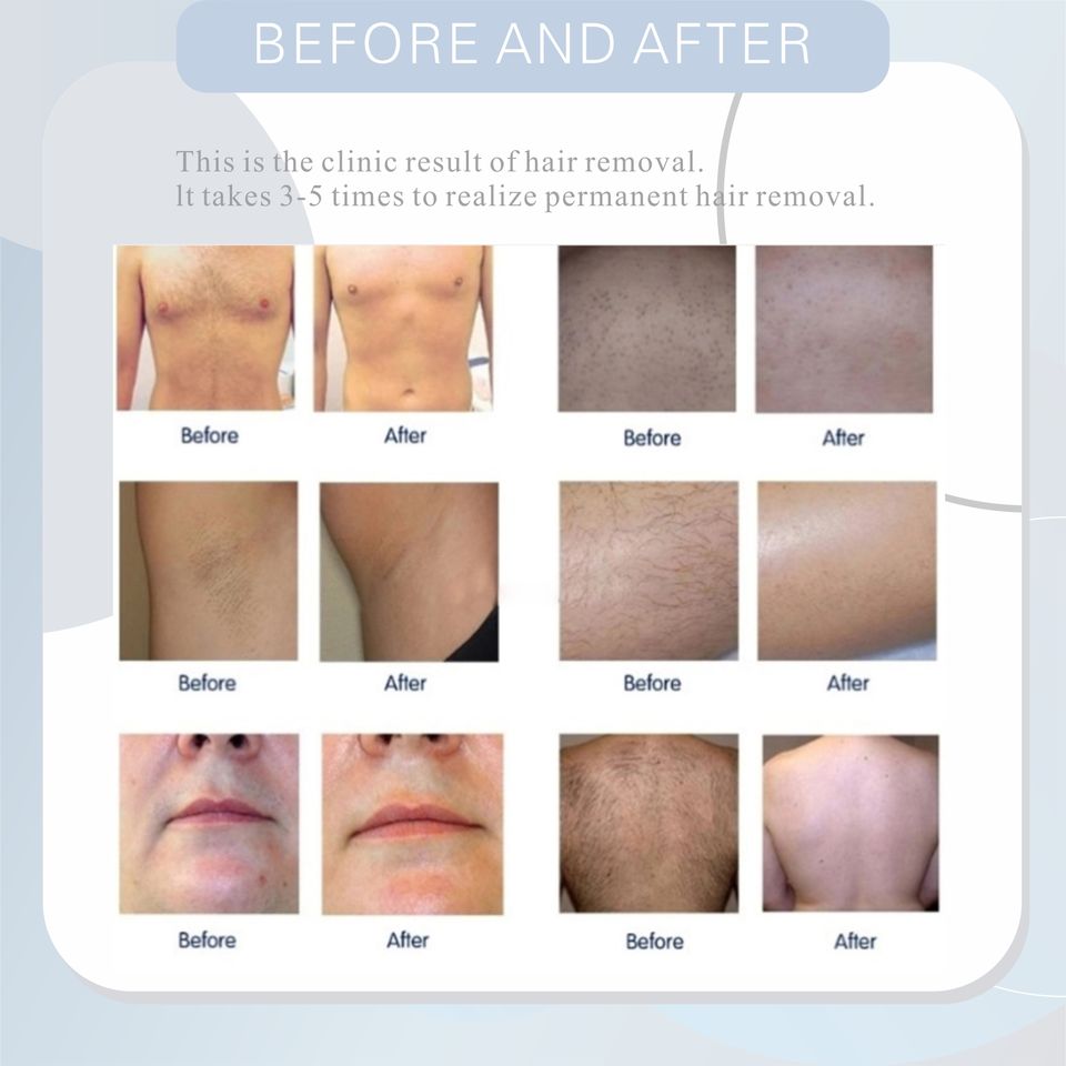 2024 Diode laser hair removal machine 3 wavelength 808nm 755nm 1064nm with 3500 watts skin rejuvenation 3 times remove hair forever