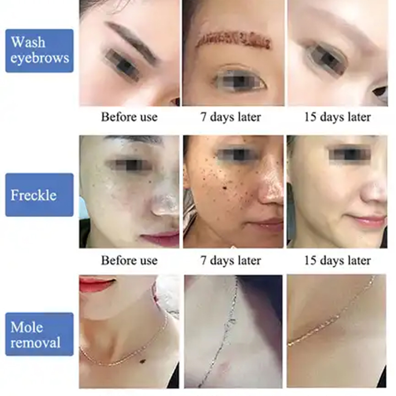 Hot Selling Picosecond Laser Tattoo Removal Spot Removal 755 1064 1320nm Nd Yag Laser Skin Tightening Whitening Beauty Machine