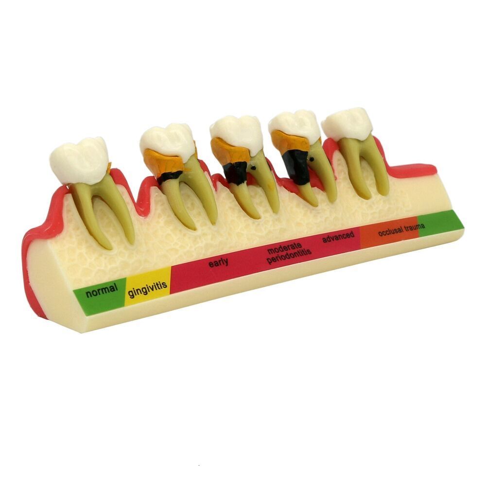 Dental Floss Pathological Typodont Teeth Model PeriodonticsImplantEndodontic Caries dental 230421