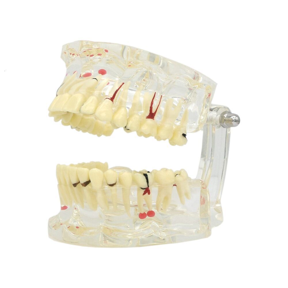Dental Floss Pathological Typodont Teeth Model PeriodonticsImplantEndodontic Caries dental 230421